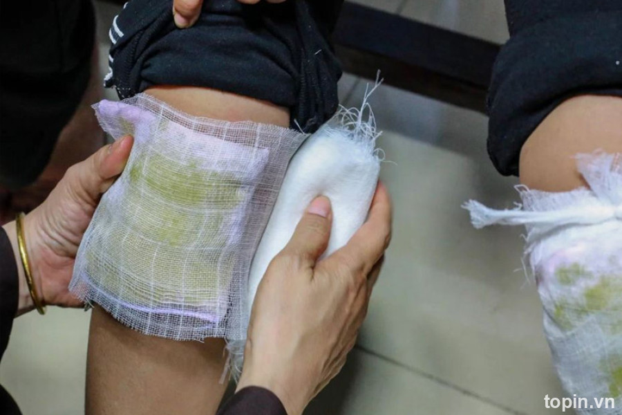 Thầy Lang Bó Thuốc Huy Gù